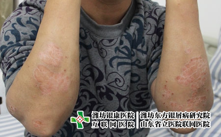 如何全面認(rèn)識牛皮癬，銀屑病是怎么回事