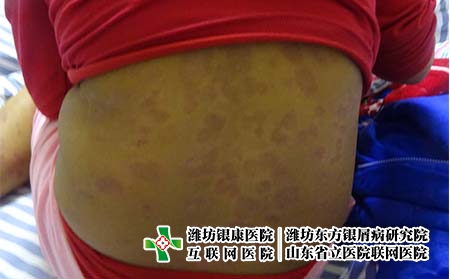 為什么成年人會患上銀屑病，牛皮癬反復的原因