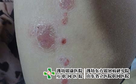 牛皮癬的自我診斷，銀屑病怎么認定