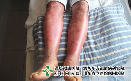 紅皮型銀屑病能自己好嗎，牛皮癬該怎么辦