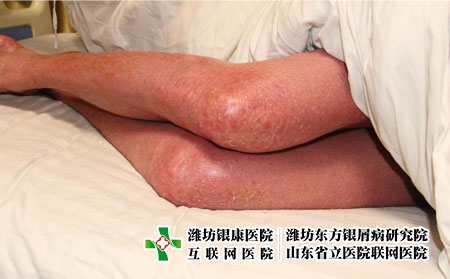 銀屑病從尋常型轉變紅皮病型的因素，為什么會得紅皮型牛皮癬