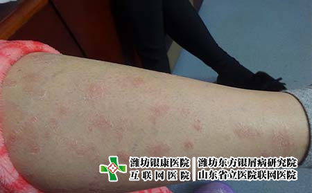尋常型銀屑患者脫屑是好轉嗎，牛皮癬掉皮怎么回事