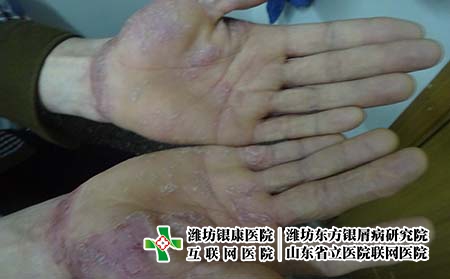 牛皮癬患者飲食有哪些，銀屑病忌口知多少