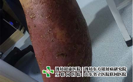 銀屑病的病因有哪些，生活中什么會(huì)導(dǎo)致牛皮癬