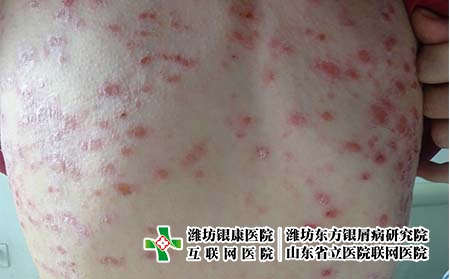 醫生對于牛皮癬治療有何妙解，銀屑病怎么治好的快