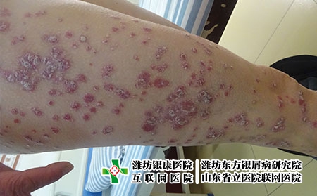 治療銀屑病要花多少錢，濰坊治牛皮癬貴不貴