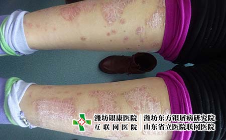 女性腿部銀屑病應該怎么治，腿上的牛皮癬很難治怎么辦