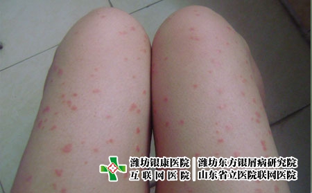 女性腿部銀屑病的治療，得了牛皮癬該怎么辦