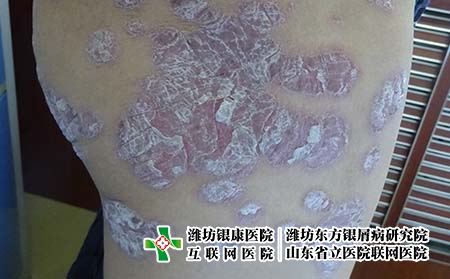 得了銀屑病很害怕怎么辦，牛皮癬的特點有哪些