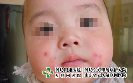 兒童為什么得銀屑病，孩子得牛皮癬的原因