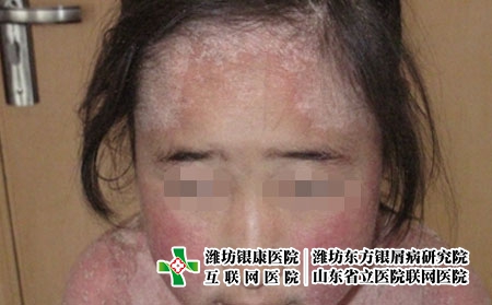 牛皮癬病人心態怎么調整，得了銀屑病如何面對