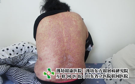 銀屑病是怎么造成的，中西醫(yī)對牛皮癬病因的認(rèn)識有哪些