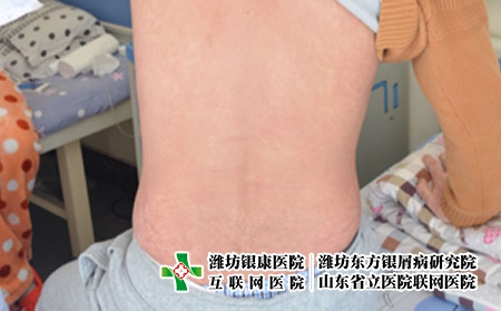 在濰坊治療銀屑病怎么選擇醫院,哪的醫院能治牛皮癬 在濰坊治療銀屑病怎么選擇醫院,哪的醫院能治牛皮癬