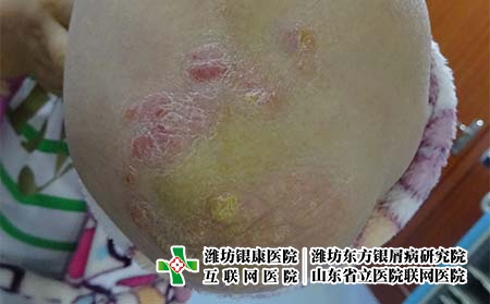 尋常型銀屑病的治療過程是什么，牛皮癬的發(fā)展階段有什么不同