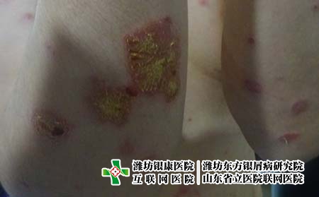 濰坊牛皮癬治療效果好的醫(yī)院，哪家銀屑病醫(yī)院口碑好