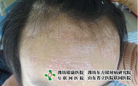 早期銀屑病治療的益處都有哪些，剛得牛皮癬要怎么辦