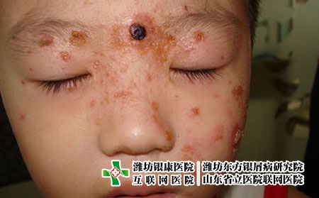 兒童牛皮癬的解決辦法，孩子有銀屑病怎么辦