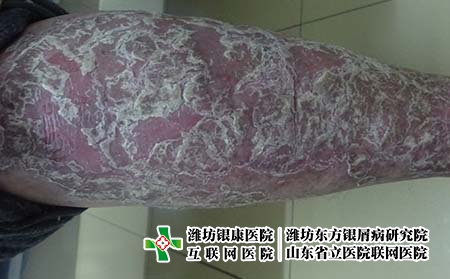 山東省治療銀屑病在哪里好，在濰坊哪家醫院治療牛皮癬比較好?