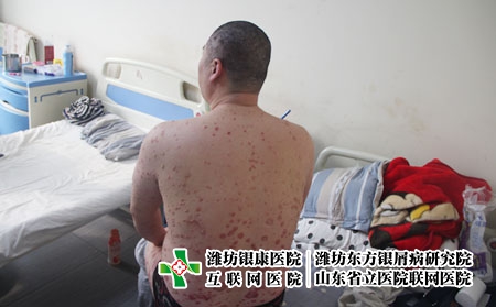 尋常型銀屑病的表現(xiàn)，牛皮癬剛開始是什么樣的