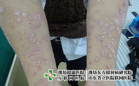 濰坊治牛皮癬的醫院哪個好點，山東濰坊哪里看牛皮癬病好?