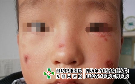 兒童銀屑病治療時要注意哪些,兒童牛皮癬的注意事項 兒童銀屑病治療時要注意哪些,兒童牛皮癬的注意事項
