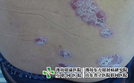 牛皮癬患者護理注意哪些事項，得了銀屑病要怎么護理