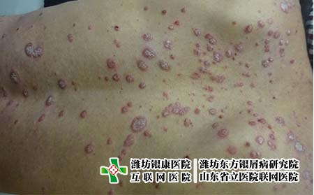 牛皮癬為什么會反復發作，銀屑病復發的原因