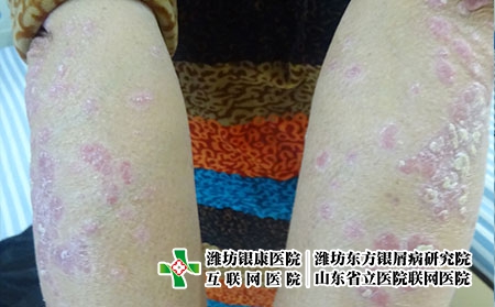 濰坊牛皮癬的專科醫院?在哪家醫院治療銀屑病好?