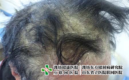 導致頭部發生牛皮癬的原因,銀屑病為什么長頭上 導致頭部發生牛皮癬的原因,銀屑病為什么長頭上