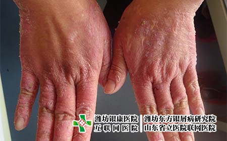 如何護(hù)理手部牛皮癬,手上長銀屑病老不好怎么辦 如何護(hù)理手部牛皮癬,手上長銀屑病老不好怎么辦