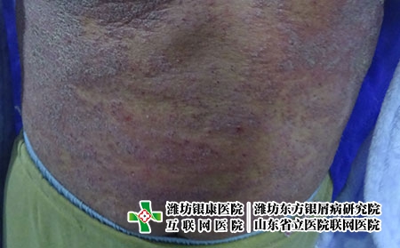 尋常型銀屑病是日常生活中常見的皮膚病。常見的發病是改變患者的皮膚狀況。尋常型銀屑病的主要發病部位是人的四肢、軀干和頭部，因此也會影響患者的容貌。這時，應該盡快處理。然而，許多人不知道治療尋常型銀屑病要花多少錢。下面大伙就與小編一起去看看，治療尋常型銀屑病要準備多少錢。  尋常型銀屑病的治療費用情況還與其它因素也是有關系的，比如醫療技術、醫療服務和醫院的公益性等都有關的。而一般大型的醫院治療尋常型銀屑病始終嚴格執行醫療收費標準，從尋常型銀屑病患者切身利益著想，堅守用優惠的價格、誠信的醫療、精湛的技術打造真正為老百姓謀健康的醫療品牌。醫院堅決貫徹病人收費項目公開、透明、合理的收費制度。同時加大公眾的監管力的同時，促使醫院內部的價格管理制度更為健全。  尋常型銀屑病的治療方法決定了尋常型銀屑病的治療費用，尋常型銀屑病患者選擇療效高的治療方法，短期內便能治好，且能有效防止復發，尋常型銀屑病患者選擇不規范的治療方法，治療起來費時費力，且有再次發作的可能。這樣算下來，自然是選擇高效方法受益較多，盡管暫時花費高了一點，但治療尋常型銀屑病屬于一次性的，如果采用不規范方法治療，一旦出現復發情況，治療費用便沒有個準。  治療費用根據癥狀來看能分為尋常型銀屑病、膿皰型銀屑病、關節型銀屑病和紅皮型銀屑病四大類型，不同癥狀其皮損分布和治療難度是不一樣的，但不管哪種類型的銀屑病，發現越早，治療越早，則治療起來也越容易，花費自然也會少，而且對患者本身來說也避免了病情變嚴重后所帶來的一系列危害。  通過閱讀以上內容，相信大家對尋常型銀屑病的治療都有了清晰的認識。除了專業治療，尋常型銀屑病患者也應該有健康的飲食習慣。他們一生中可以吃更多的蔬菜和水果，并且可以吃更多的粗糧和粗糧作為主食。這些對尋常型銀屑病的疾病控制具有良好的效果。