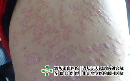 牛皮癬能吃什么蔬菜,銀屑病吃什么好 牛皮癬能吃什么蔬菜,銀屑病吃什么好