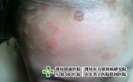 頭皮牛皮癬應該怎么治療，頭部長銀屑病怎么辦