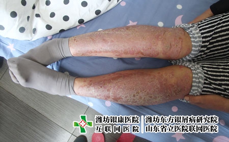 男性患牛皮癬的原因都有哪些,什么會導致銀屑病 男性患牛皮癬的原因都有哪些,什么會導致銀屑病