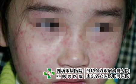 兒童牛皮癬患者如何護理,孩子銀屑病怎么辦 兒童牛皮癬患者如何護理,孩子銀屑病怎么辦