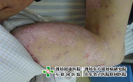 濰坊治療銀屑病的醫(yī)院哪家比較好，濰坊牛皮癬在哪家治療?