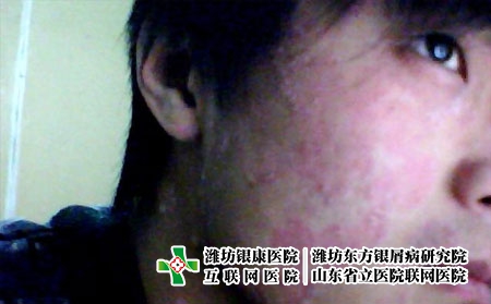 牛皮癬可以治好嗎，得了銀屑病能不能治好