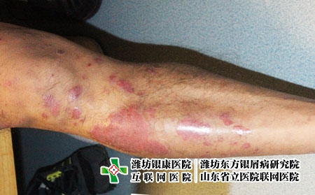 銀屑病關(guān)節(jié)炎怎么辦，關(guān)節(jié)型牛皮癬怎么治療