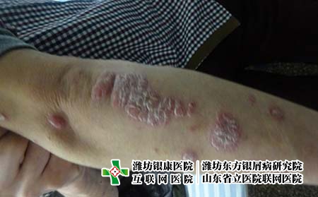 濰坊銀屑病醫院的有效治療方法，得了牛皮癬咋辦好