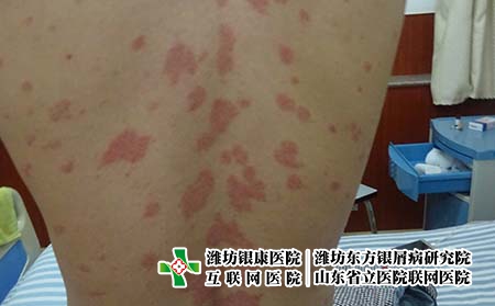 尋常型銀屑病如何治效果才好，治療牛皮癬要注意什么