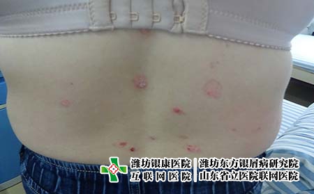 濰坊牛皮癬那里治得好?哪家醫院專業治療銀屑病?