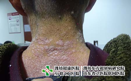 牛皮癬是有什么樣的病因引起，銀屑病是怎么得上的