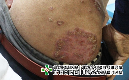 銀屑病圖片及治療方法?牛皮癬是如何被發現的