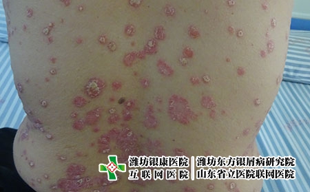 什么會影響銀屑病的發作,牛皮癬發病受什么影響 什么會影響銀屑病的發作,牛皮癬發病受什么影響