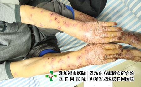 缺微量元素會(huì)誘發(fā)銀屑病嗎,牛皮癬患者要注意哪些飲食問題 缺微量元素會(huì)誘發(fā)銀屑病嗎,牛皮癬患者要注意哪些飲食問題