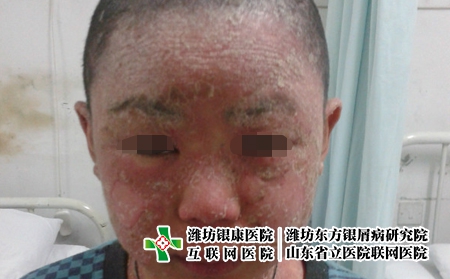 為何小孩會(huì)患有牛皮癬，導(dǎo)致兒童牛皮癬發(fā)病都有哪些原因?