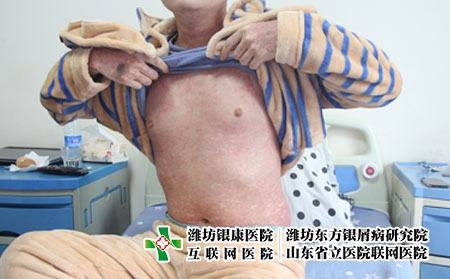 保健品對銀屑病的作用，牛皮癬患者能吃保健品嗎