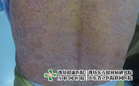 治療銀屑病一般要多少錢，治牛皮癬的花費是多少