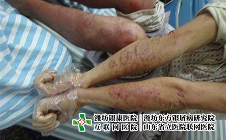 牛皮癬患者如何選擇水果,銀屑病吃什么好 牛皮癬患者如何選擇水果,銀屑病吃什么好