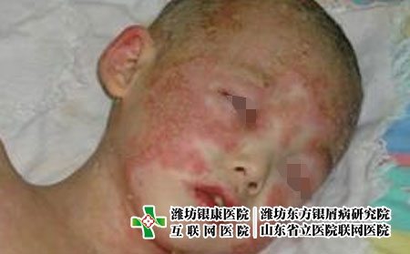 孩子為什么得銀屑病?導致兒童患上牛皮癬的原因是什么